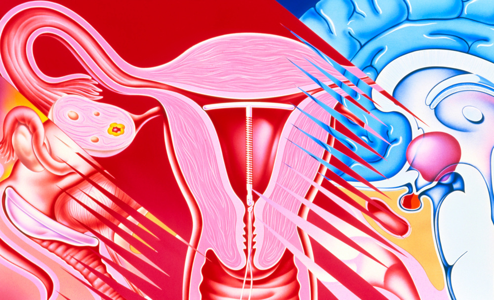 자궁내 구리장치 iud