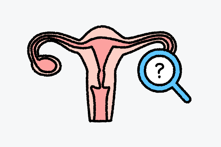 다낭성난소증후군